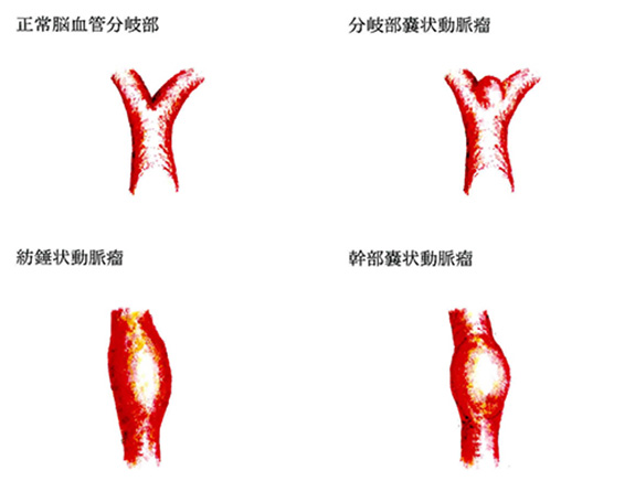 MRI検査について